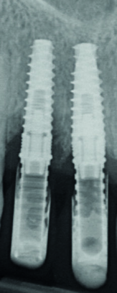 Fig. 8 : Radiographie « long-cône » de contrôle à deux mois.