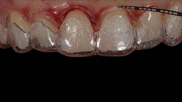 Figs. 6a y 6b. Ajuste intraoral de la guía quirúrgica para alargamiento de coronas.