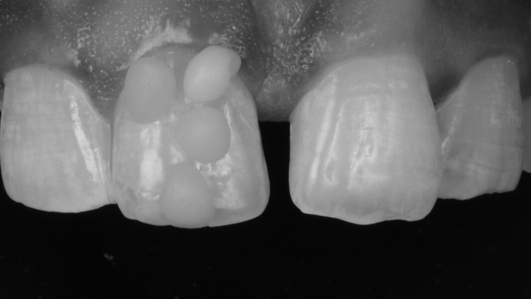 Fig 3.  A monochrome photograph helps evaluate the Value. A3 Enamel was chosen for this case.
