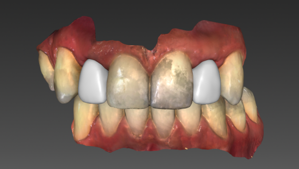 Prace na implantach w strefie estetycznej po leczeniu ortodontycznym – wykorzystanie skanera wewnątrzustnego