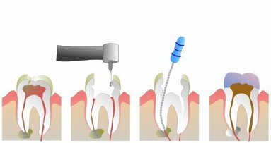 Una nuova procedura dentale potrebbe sostituire la devitalizzazione
