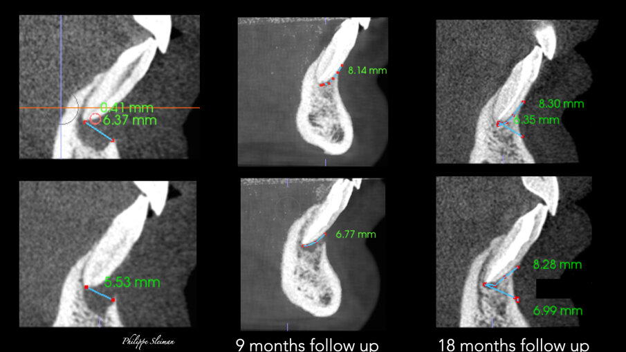 Slike 9a–f: Poređenje vertikalnih prikaza i-CAT skeniranja snimljenih pre operacije (a i b) i tokom devetomesečnog praćenja (c & d) i 18-mesečnog praćenja (e & f) pokazujući kontinuirani rast kosti vertikalno