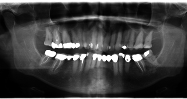 CBCT as a diagnostic and treatment planning tool and assessment of low dose programs for endodontic follow-up cases