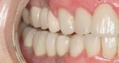 Soft-tissue collar around implants: A periodontal compromise or not?
