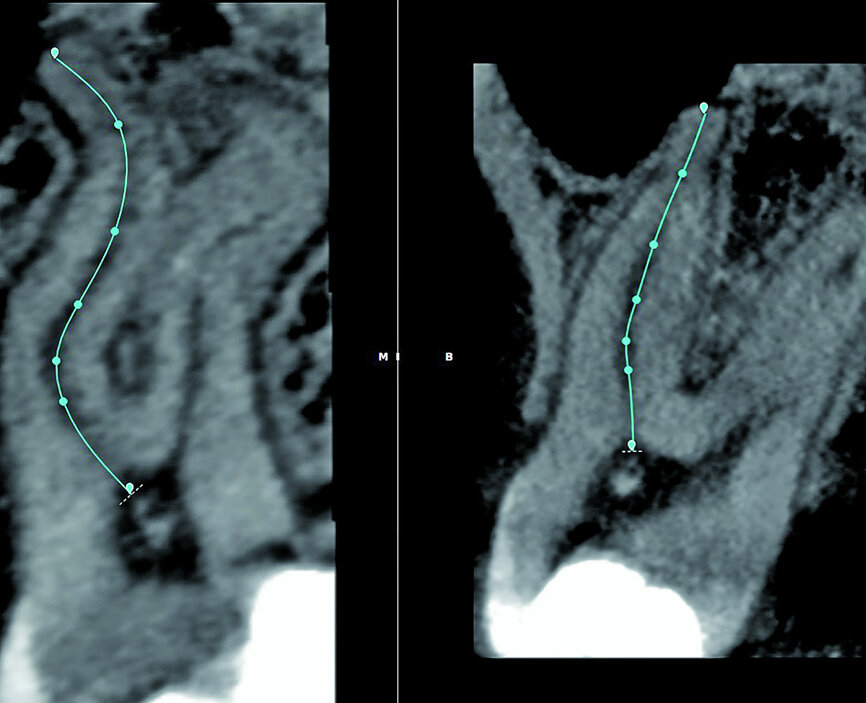 Fig. 10: Corrections made for the distobuccal root canal according to the canal configuration that can be viewed in different planes in the software.