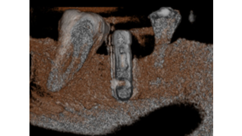 Fig 7. Imagen de reconstrucción del volumen donde se puede observar aumento de la densidad ósea en distal y mesial del implante.