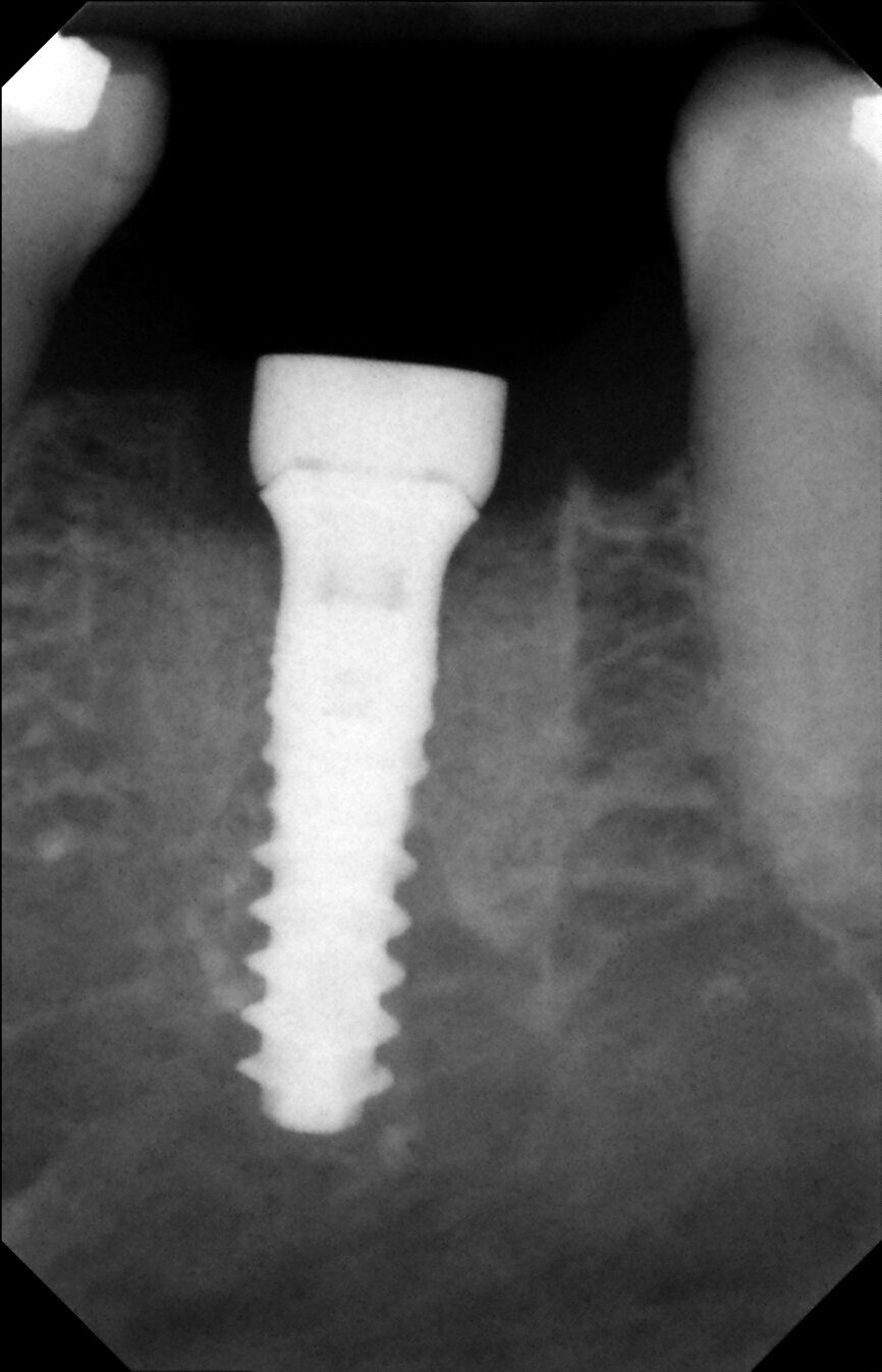 Fig. 17: Periapical radiograph after implant placement.