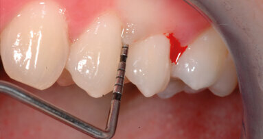 Terapia parodontale non chirurgica con approccio “One-Stage Full-Mouth Disinfection”