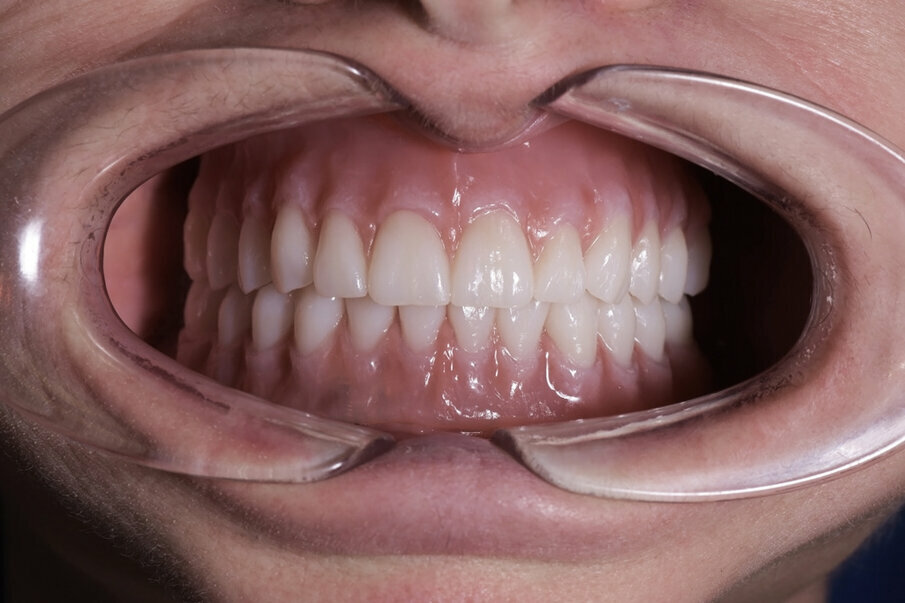 Fig. 23: Individualised, digitally produced complete maxillary and mandibular dentures in situ (CediTEC).