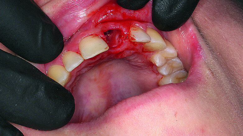Fast, functional aesthetic solution for anterior tooth trauma