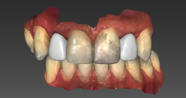 Prace na implantach w strefie estetycznej po leczeniu ortodontycznym – wykorzystanie skanera wewnątrzustnego