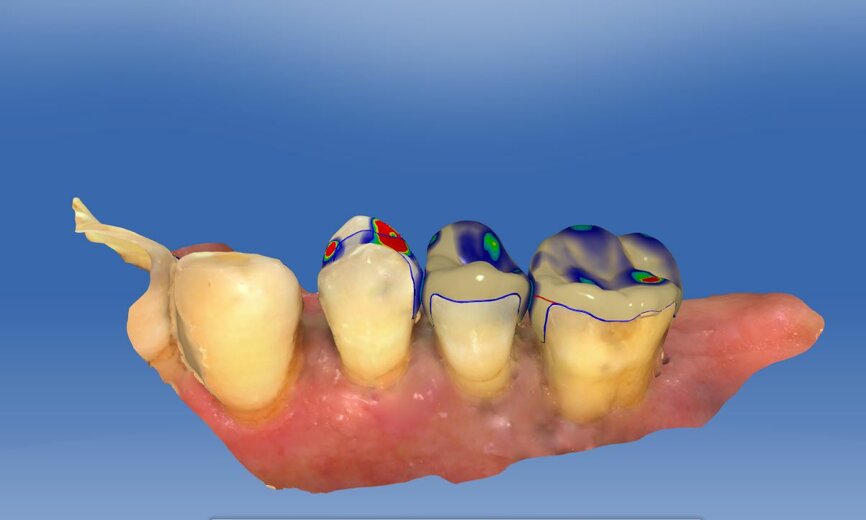 Fig. 4b: Illustrative image of the CAD construction in the posterior segment of the maxilla.