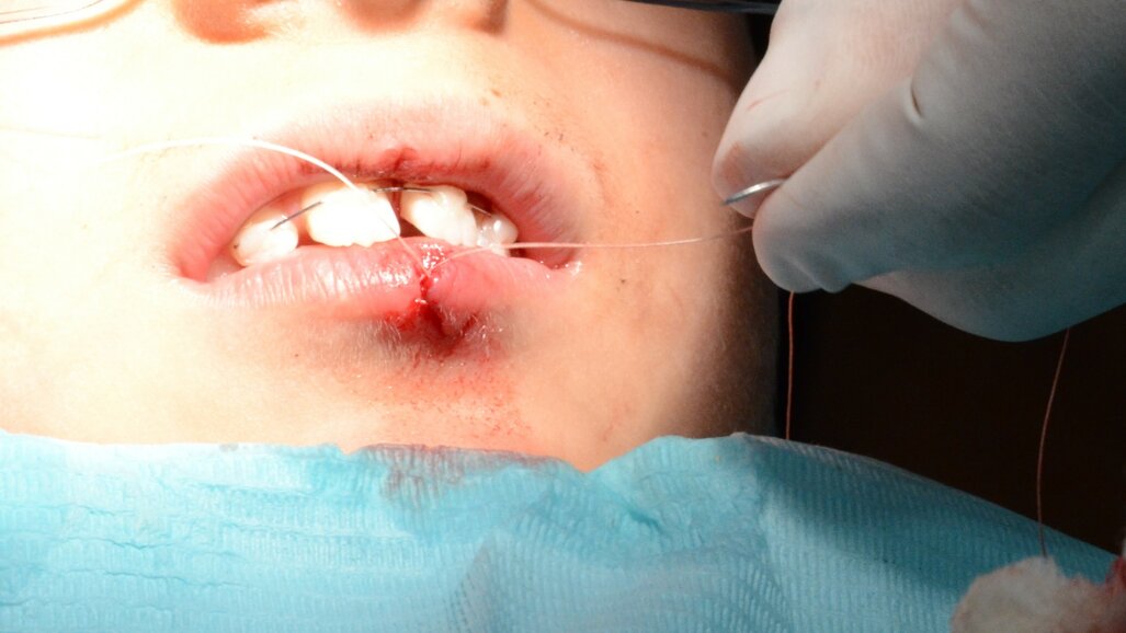 Avulsion in Paediatric Dentistry: Management  of a Double Dental Emergency in a Child