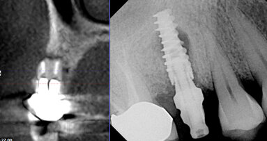 Avoiding the pitfalls of implants with 3-D imaging