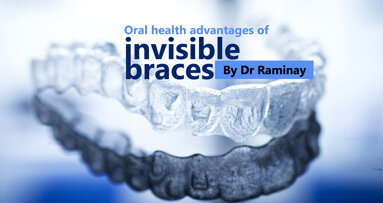 Oral health advantages of invisible braces