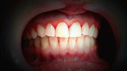 Despite good oral hygiene, localised gingivitis can affect distant healthy areas in mouth