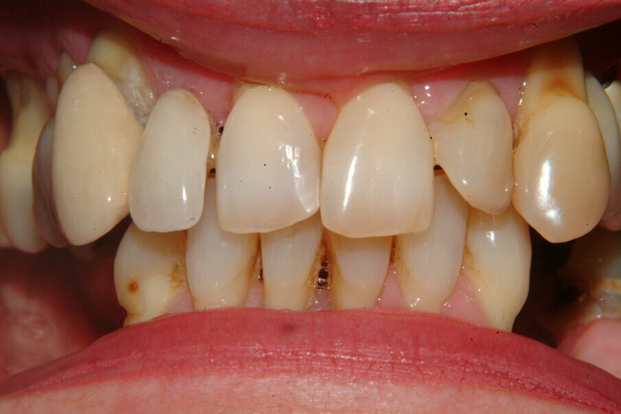 Fig 2. Advanced periodontitis and imminent tooth loss in a heavy smoker.