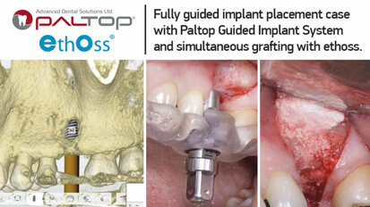Fully guided implant placement case with Paltop Guided Implant System and simultaneous grafting