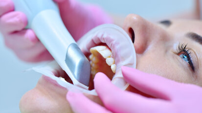 الماسح الضوئي داخل الفم بديل فعال للتقييم السريري البصري في اكتشاف التسوس