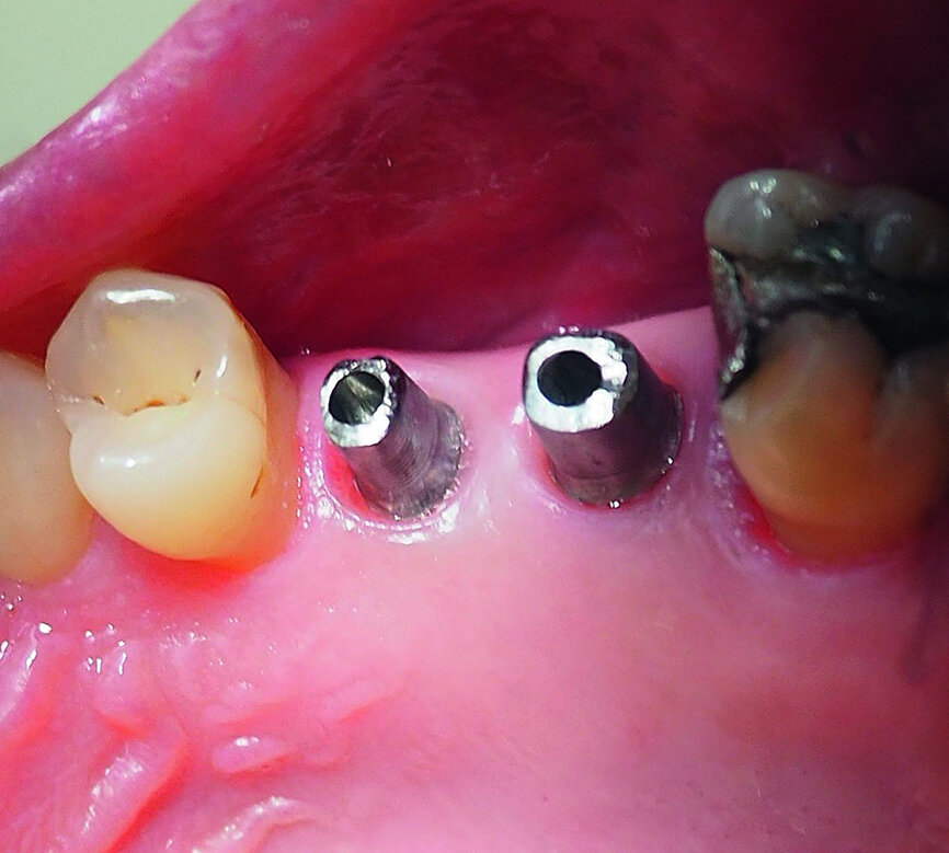 Fig. 22: Custom-made Atlantis titanium abutments fitted to the implants.