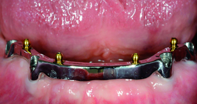 Evaluating the fit of removable dentures with magnification systems