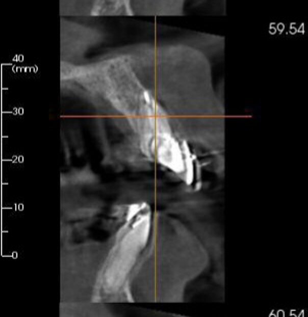Fig. 18: CBCT scan showing the horizontally fractured tooth #21.