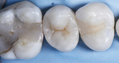 Large MODL Class II restoration with ceram.x® SphereTEC one, Palodent® V3 and SDR® Plus