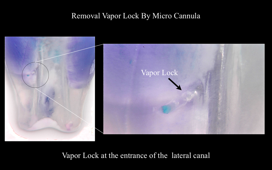 Slika 1a – Sleiman-Iandolo test. Pokazuje mehurić vazduha zarobljen u lateralnom kanalu nastao kao rezultat pasivnog ultrazvucnog ispiranja.                  Uklanjanje vazdušnog mehurića uz pomoć mikro kanile                  Vazdušni mehurić na ulazu u lateralni kanal