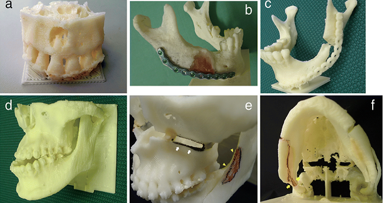 Des chercheurs développent un cadre propice à la fabrication de modèles dentaires 3D à faible coût