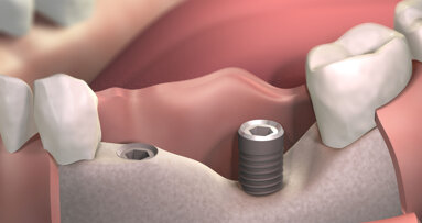 Novel coating material expected to accelerate bone regeneration for dental implant procedures