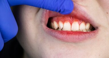 Kinderen met immuundeficiënties hebben meer kans op het ontwikkelen van parodontitis