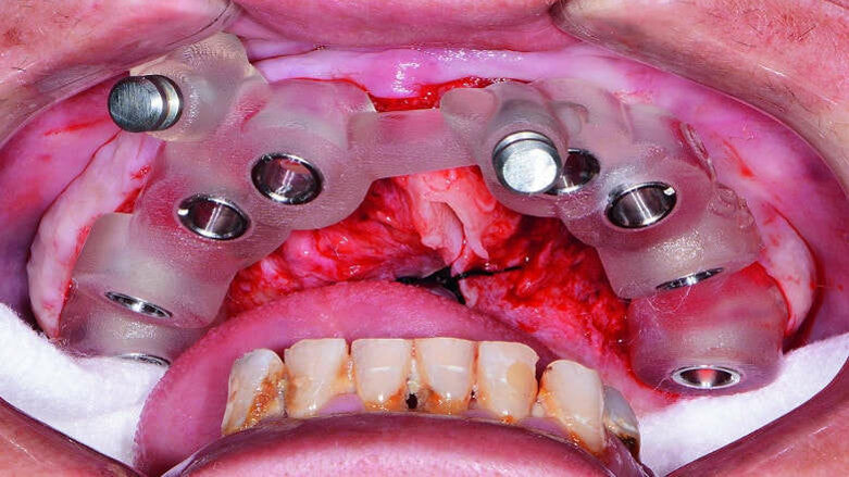 Incorporating CAD/CAM solutions for full-mouth dental implant reconstructions