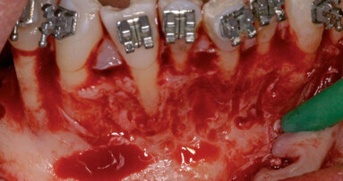 Il movimento ortodontico osteogenico e parodontalmente accelerato nel trattamento multidisciplinare implantare