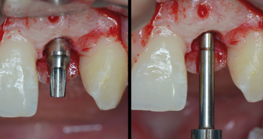 Lateral maxillary incisor implant—Key issues for esthetic success Part II