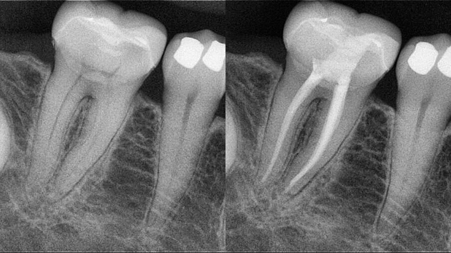 Figs. 5a & b: Root canal therapy performed in tooth #46 through a zirconia crown. The access cavity was prepared as conservatively as possible. The root canal obturation was performed by the hydraulic compaction technique.