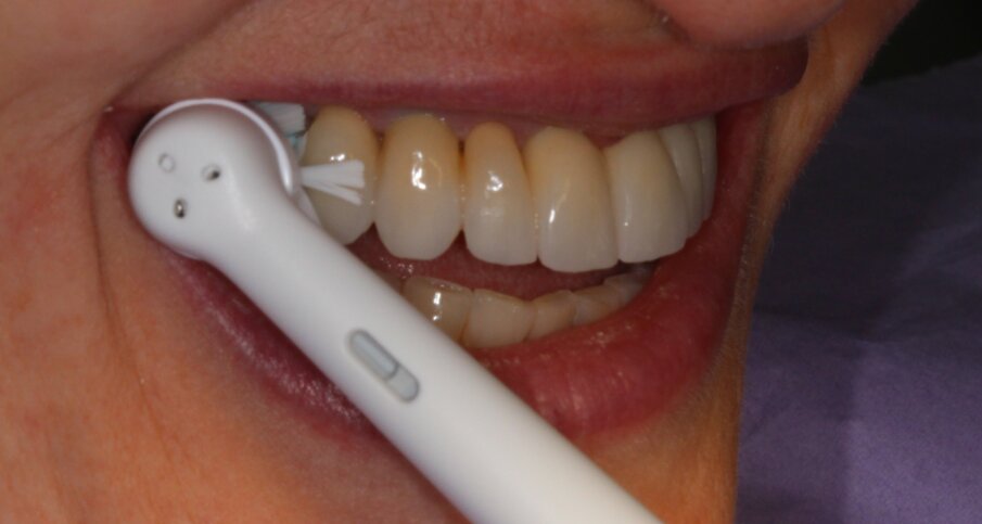 Fig. 2 - Testina Gentle Clean su struttura implanto-protesica full arch.