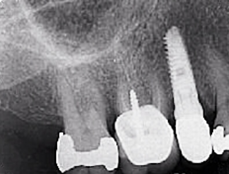 Fig. 46 : Deuxième molaire supérieure compromise (fissure et complication endodontique). 
