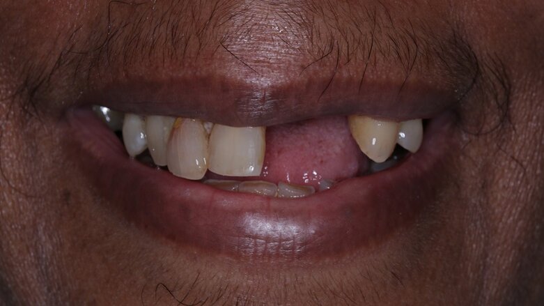 Tooth loss in Middle-aged is linked to increased coronary heart disease risk