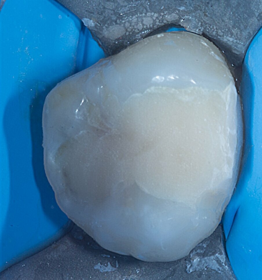 Figs. 5a: Direct restoration with everX Flow and Essentia.