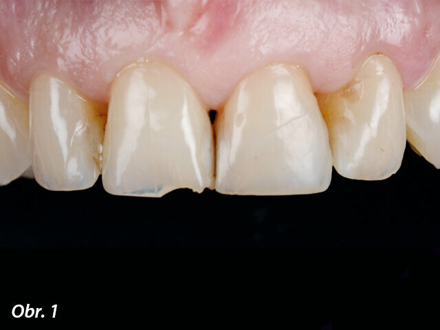 Výchozí stav ukazuje nevyhovující anatomii horních frontálních zubů a odlomenou část zubu 11.