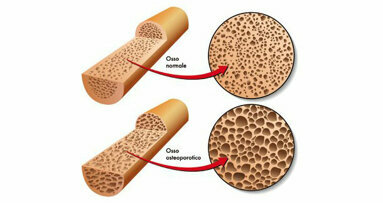 Osteoporose und Zahnersatz: Was Patienten beachten sollten
