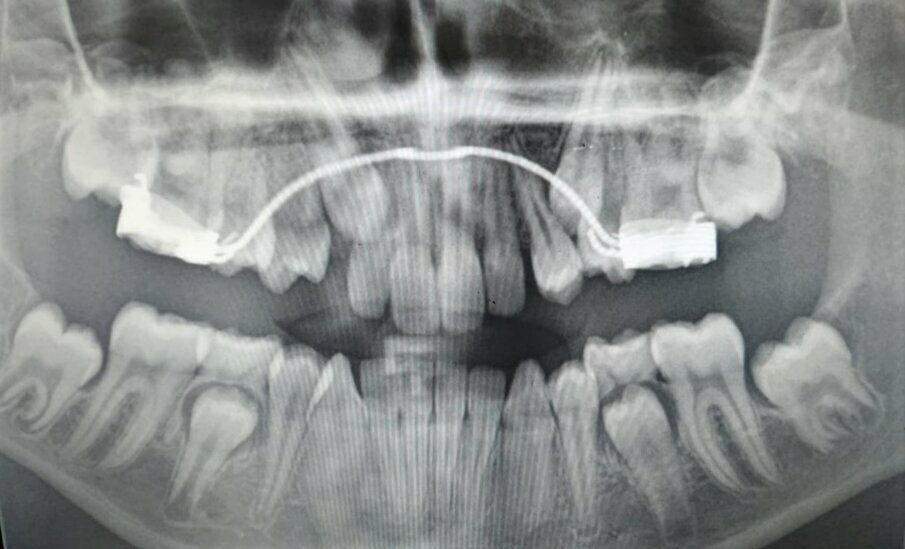 Figg. 1a, 1b - Rx-OPT della paziente 1(A) e della paziente 2(B) gemelle di anni nove e mezzo entrambe in trattamento ortodontico intercettivo. Si nota la particolare e contemporanea presenza sia della trasposizione canina-premolare sia della ritenzione canina superiore.