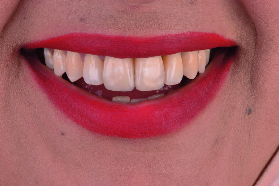 Fig 20. Rejuvenated smile achieved with MICD restorative approach