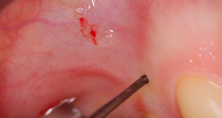 Soulevé de sinus et ostéotenseur : le Fractal lift Taux de succès sur une période de 2 à 6 ans