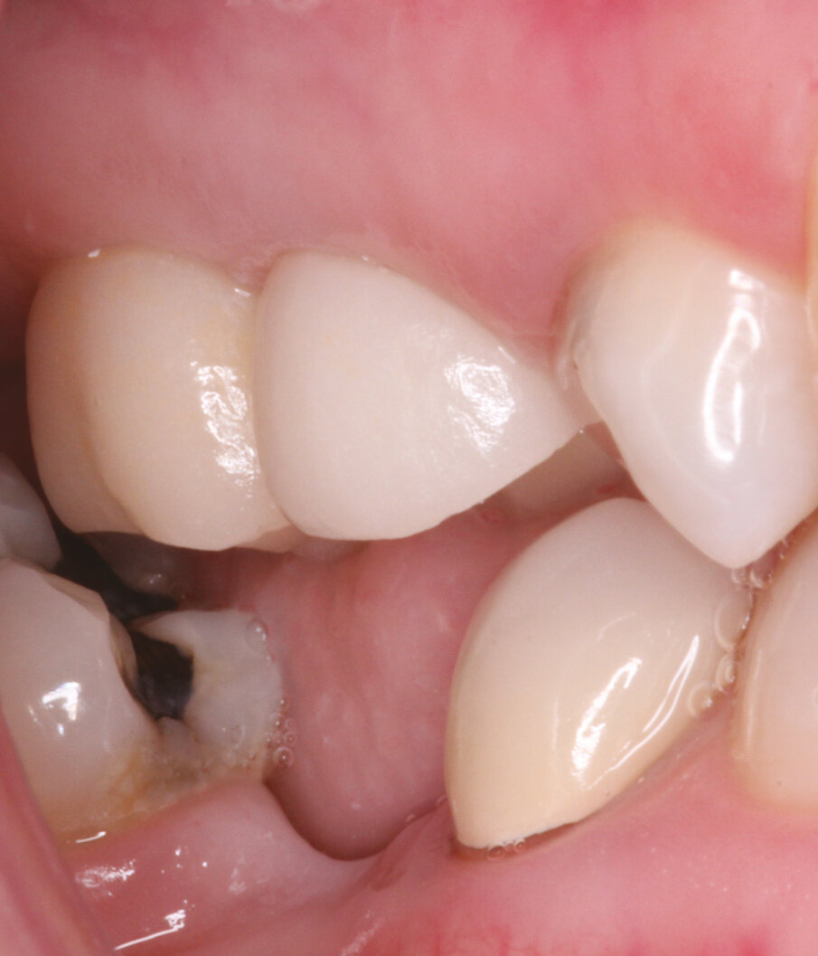 Figs.16: Final zirconia crowns placed
