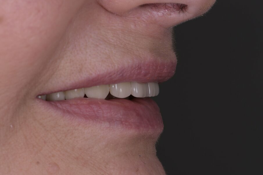 Fig. 48_Eseguendo fotografie laterali dx e sx riusciamo a vedere la naturale posizione del labbro superiore a riposo e nel sorriso, confrontandole (Fig. 3) riscontriamo il successo nella rimozione della flangia in resina con una rigenerazione ossea e con la forma coronale, rimuovendo il codice a barra presente in Figura 4.