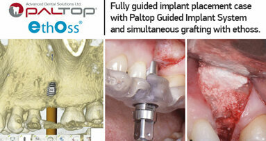 Fully guided implant placement case with Paltop Guided Implant System and simultaneous grafting