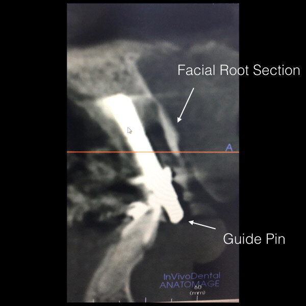 Fig. 19: CBCT scan showing the facial root section and the guide pin in place.