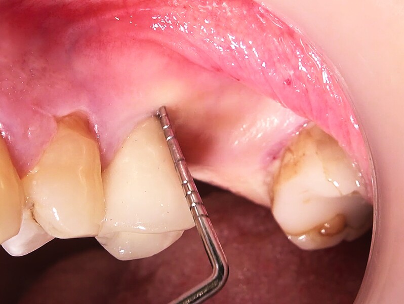 Fig. 36 : Région molaire édentée avant l’implantation. 