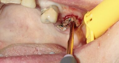 Maxillary first molar atraumatic extraction